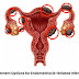 Treatment Options for Endometriosis-Related Infertility
