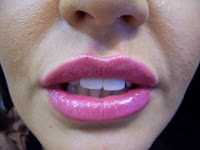 Bracknell Dentist offers Luscious lips by Dr Teresa as well as cheek fillers