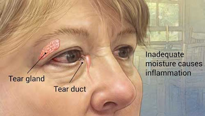 How to treat dry eye