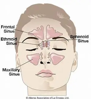 Types of headaches and remedies