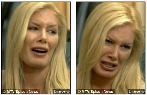 heidi montag surgery gone wrong. heidi montag surgery gone