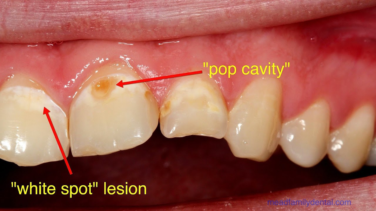 How Do Cavities Start