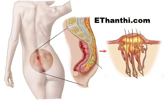 நீர் கட்டி (Cyst) என்றால்