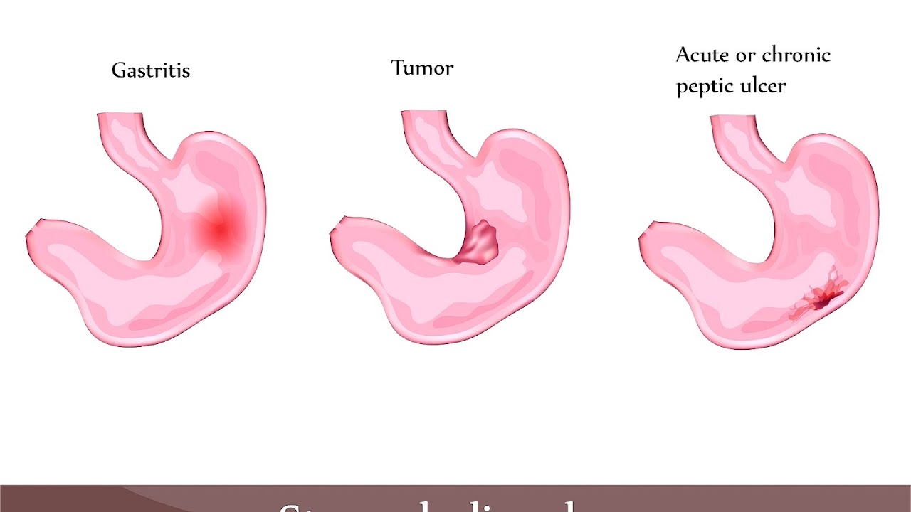 Home Remedies For Stomach Ulcer Pain