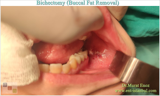 Bichectomy, Buccal Fat Removal, Buccal fat extraction, Hollywood cheek, Cheek Thinning Surgery, Cheek Fat Removal, Extended buccal lipectomy