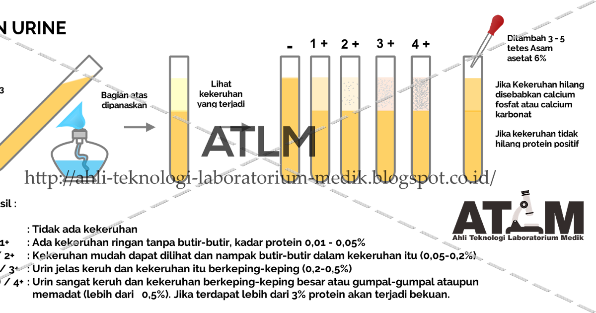 Pemeriksaan Protein Urin Dengan Pemanasan  ATLM