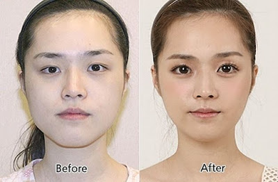 15 Foto 'Before - After' Hasil Operasi Plastik yang Menakjubkan