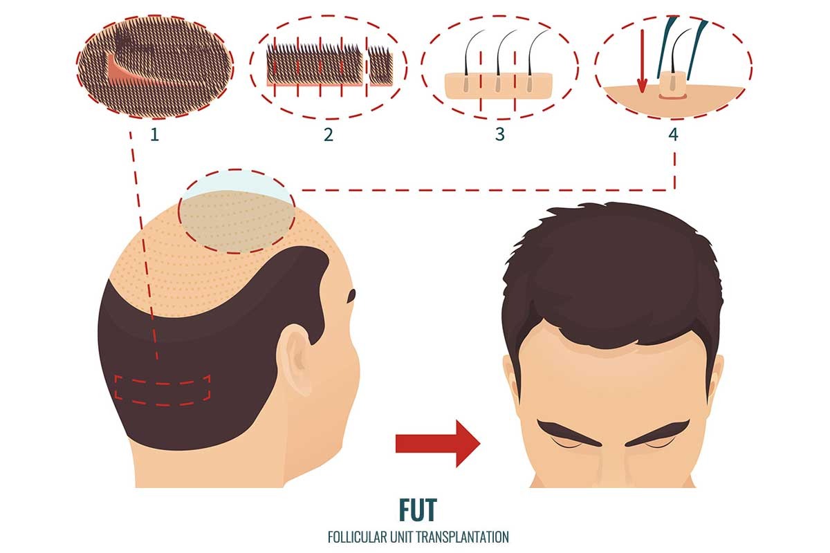 FUT (Follicular Unit Transplantation)