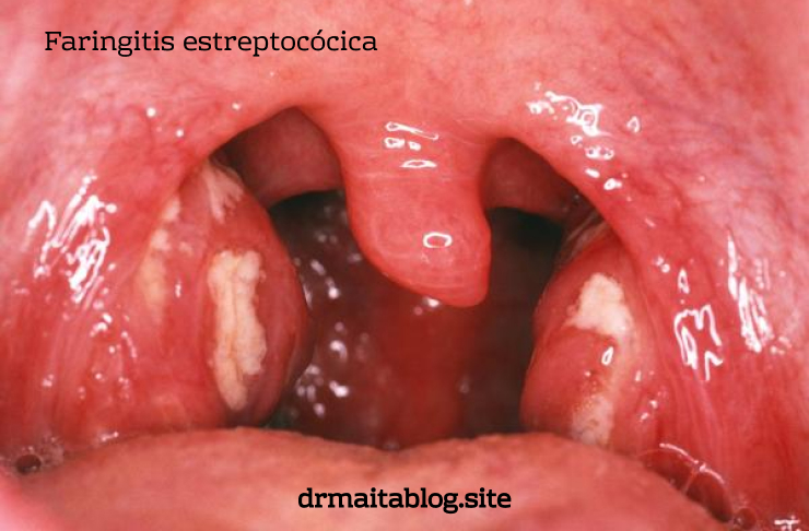 Faringitis estreptocócica