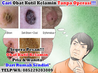 Obat Kutil Kelamin