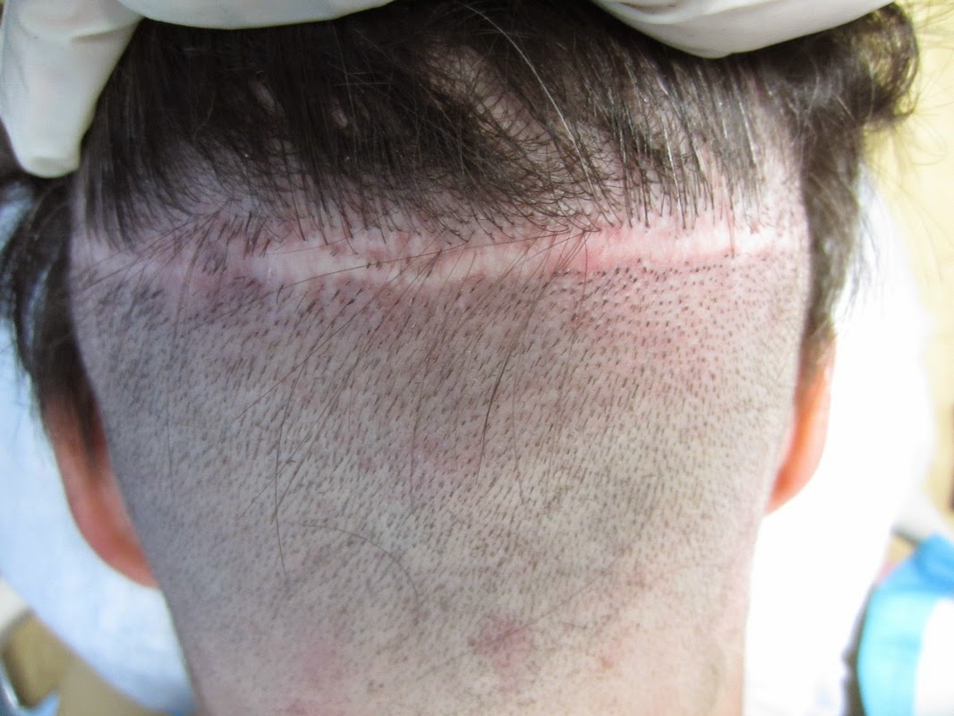 Hair Transplant Surgery Due to FUT