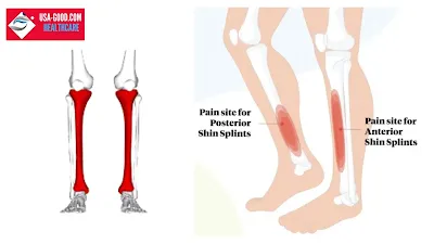 What are Shin splints?