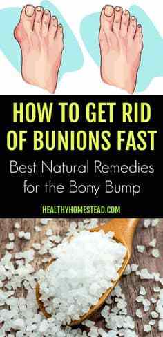 How to Get Rid of Bunions Fast – Best Natural Remedies for the Bony Bump