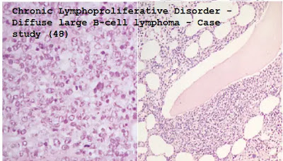 Case study (48) – Chronic Lymphoproliferative Disorder - Diffuse large B-cell lymphoma