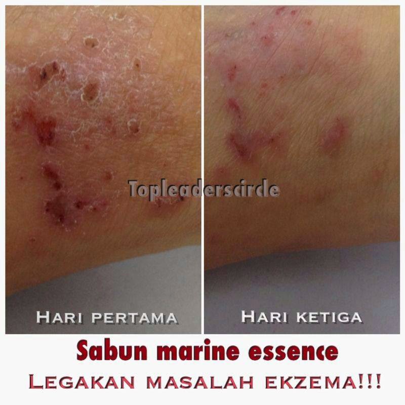 Ubat Untuk Hilangkan Eczema - Yuralah