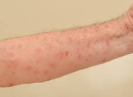 Bintik Merah Pada kulit dapat di sebabkan oleh 10 penyakit berikut ini