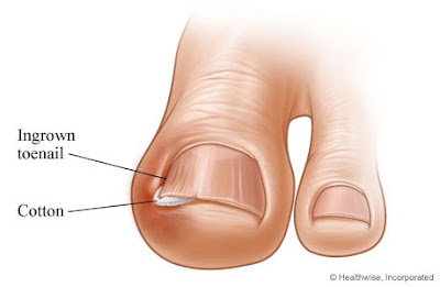 5 Langkah Nak Elak Kuku Kaki Yang Selalu Tumbuh Ke Dalam Kulit