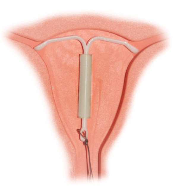 My IUD Experience - 1.5 Months Post-Insertion