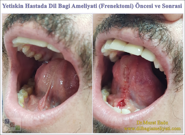 Yetişkin Hasta Dil Bağı Ameliyatı Sonrası