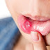 Bị viêm loét miệng phải làm sao? 
