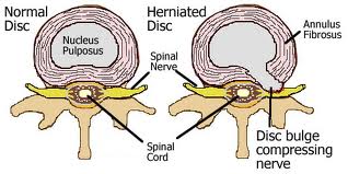 Heriniated Disc