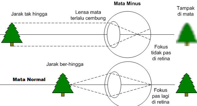 Mata minus atau rabun jauh atau dalam istilah medis disebut dengan miopia merupakan kondi Cara Mengurangi Minus Pada Mata dengan 6 Tips Ampuh