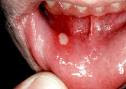 What Is a Canker Sore?