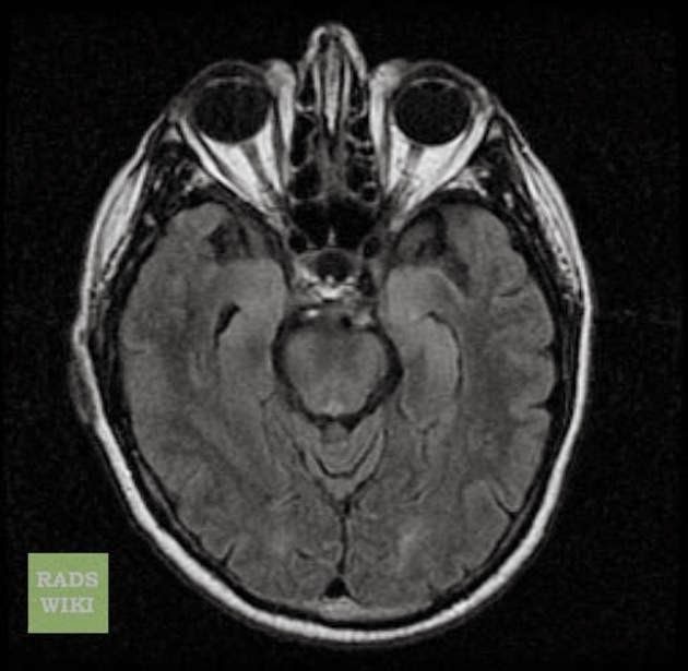  http://radiopaedia.org/articles/limbic-encephalitis