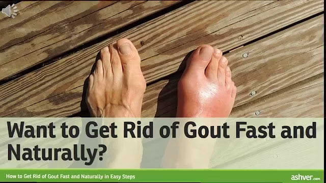 Say goodbye to gout, thanks to this strong natural recipe