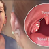 4 EFFECTIVE WAYS TO REMOVE TONSIL STONES WITHOUT SURGERY