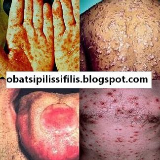 http://obatsiphilis.blogspot.com/2015/01/obat-siphilis.html