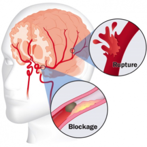 Obat stroke, obat herbal stroke, obat menyembuhkan stroke, obat menangani stroke, obat untuk stroke, obat alami stroke 