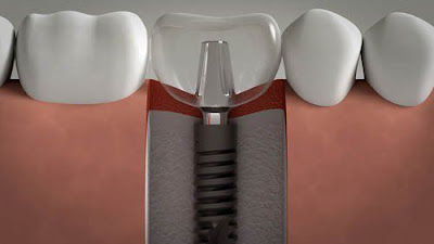 Công nghệ cấy ghép implant là gì