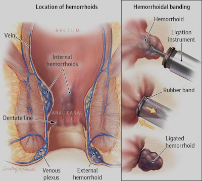 Hemorrhoids