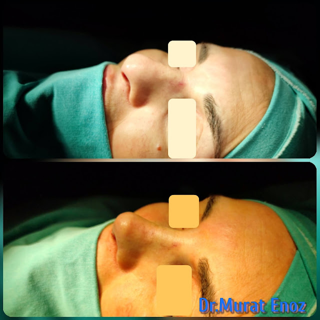 nose reshaping, nose job, Natural rhinoplasty in Istanbul,Natural looking nasal aesthetic surgery