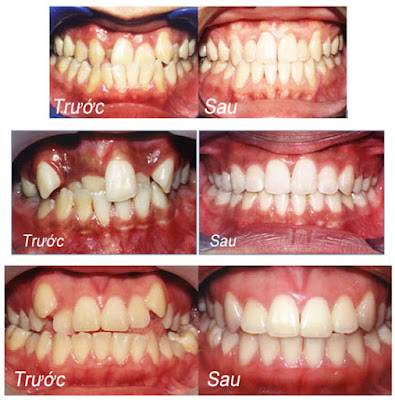 Quy trình của phương pháp niềng răng lệch lạc