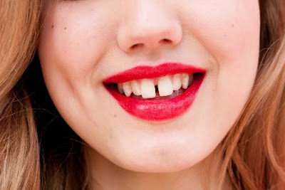 Răng cửa to và dài có khắc phục bằng niềng răng không?