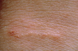 Treatment of scabies