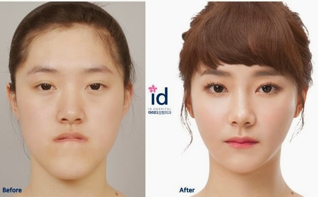 アジア最初の輪郭専門病院 韓国id美容外科です 韓国整形情報 しゃくれ顎 顎なし 馬顔 丸顔から卵型の顔になろう