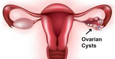 Ovarian Cysts