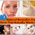 10 Natural Cure For Acne