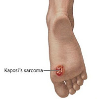 kaposi's sarcoma emedicine