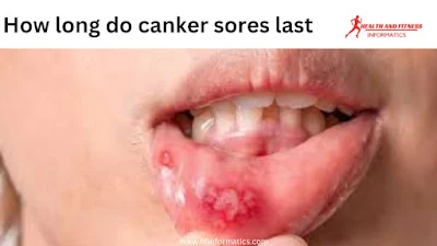 How long do canker sores last