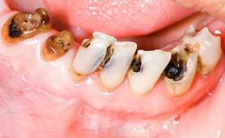 Nguyên nhân và cách chữa nhức răng cho trẻ-1