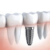 Trồng răng implant có nguy hiểm không? Áp dụng cho ai?