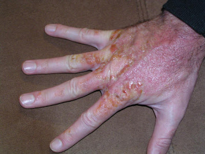 what does poison sumac rash look like. poison ivy plant rash. bad