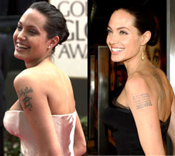 The Aesthetic Doctor's Blog: Laser Tattoo Removal – A Safe ...