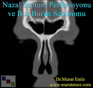 nazal septum perforasyonu + boş burun sendromu