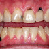 Tìm hiểu nguyên nhân dẫn đến sâu răng