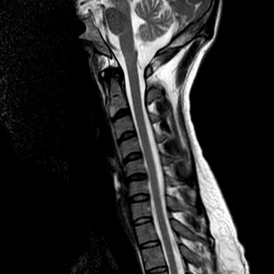 Imagen de Resonancia Magnética: vista sagital de unas cervicales rectificadas